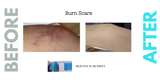 Caesarean Silicone Scar Sheet