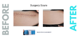 Caesarean Silicone Scar Sheet