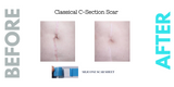 Caesarean Silicone Scar Sheet
