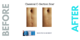 Caesarean Silicone Scar Sheet