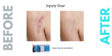 Caesarean Silicone Scar Sheet