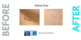 Caesarean Silicone Scar Sheet