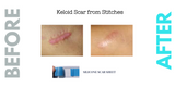 Caesarean Silicone Scar Sheet