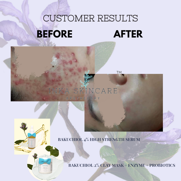 Treating Acne Results From Bakuchiol Range