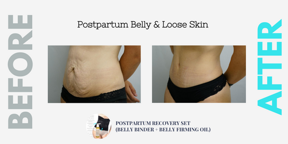 Postpartum Belly & Loose Skin (Compilation)
