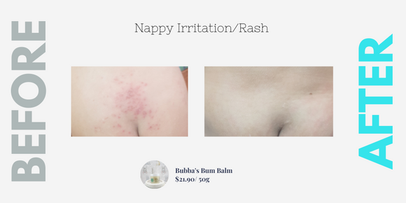 Nappy Irritation & Rash