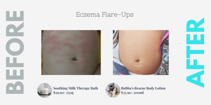 Eczema Flare-Ups in Toddlers