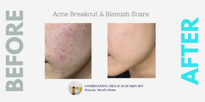 Acne Breakout & Blemish Scars