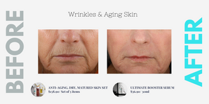 Wrinkles & Aging Skin