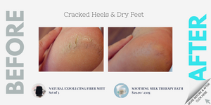 Cracked Heels & Dry Feet