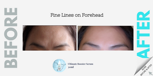 Fine Lines on Forehead