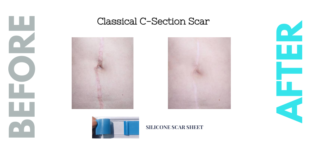 TriLASTIN C-Section Scar Sheet - Anchor